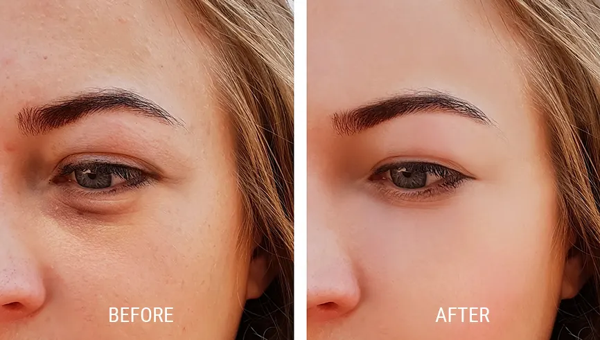PRP Under Eyes Before and After