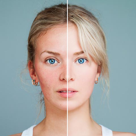 IPL Photorejuvenation