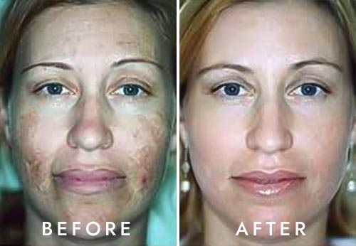 IPL Photorejuvenation Photo 2