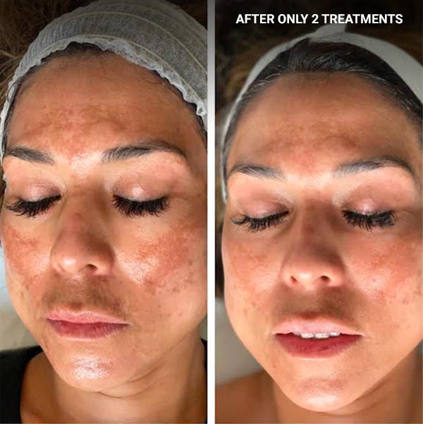 After 2 treatments of enzyme facial