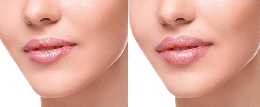 Lip Filler Results