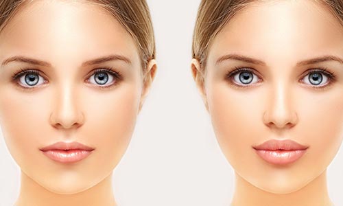 Lip Filler Benefits