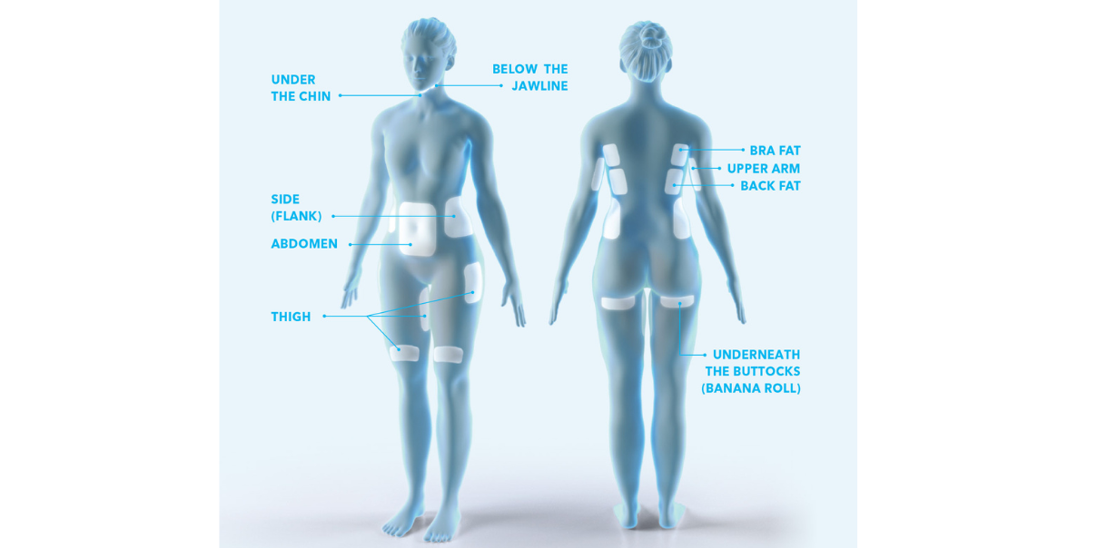 coolsculpting elite mn