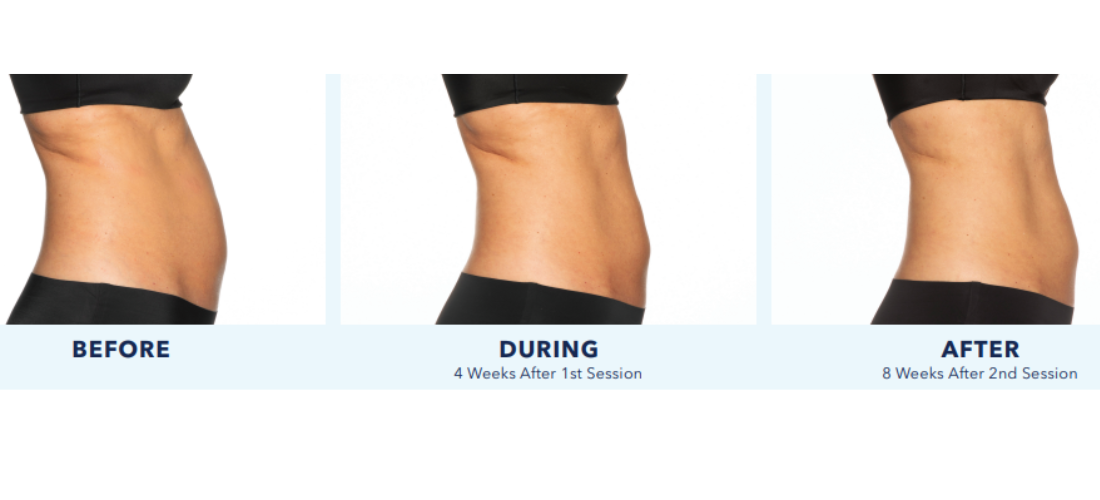 coolsculpting elite mn