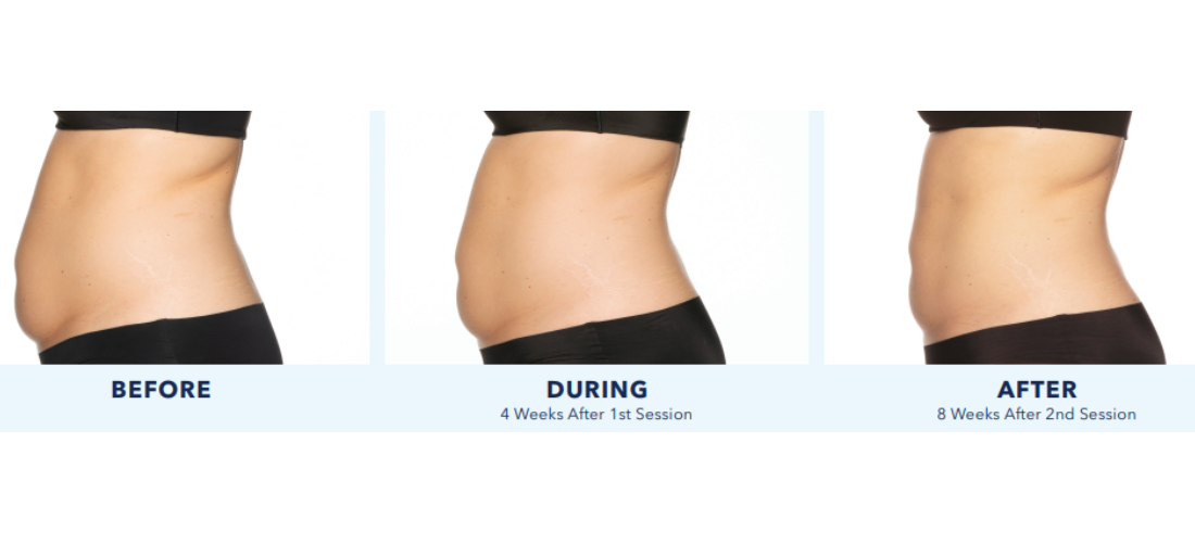 coolsculpting elite mn