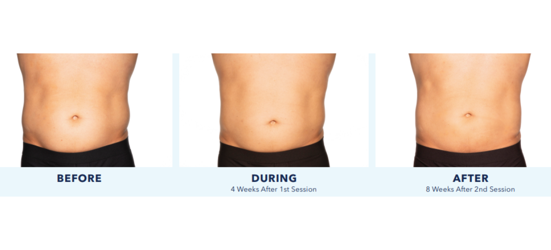 coolsculpting elite mn
