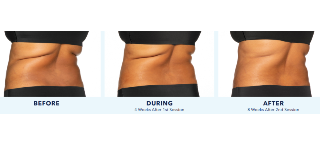 coolsculpting elite mn