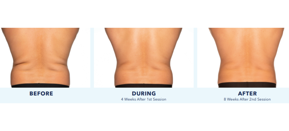 coolsculpting elite mn