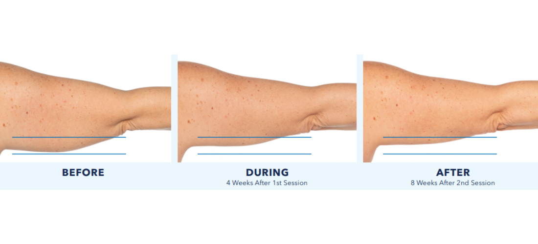 coolsculpting elite mn