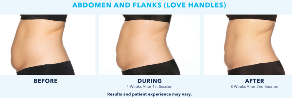 CoolSculpting Treatment for Love Handles—Reduce Unwanted Waist Fat